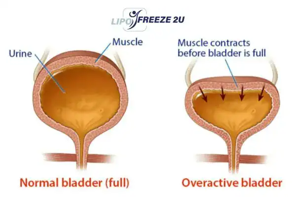 diagram of overactive bladder treatment Stoke-on-Trent