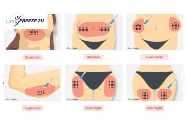 Benefits of Choosing Aqualyx for Fat Reduction Stoke-on-Trent