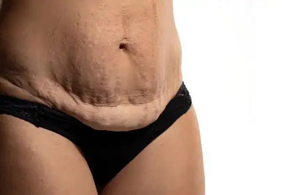 loose skin after weight loss injections Stoke-on-Trent