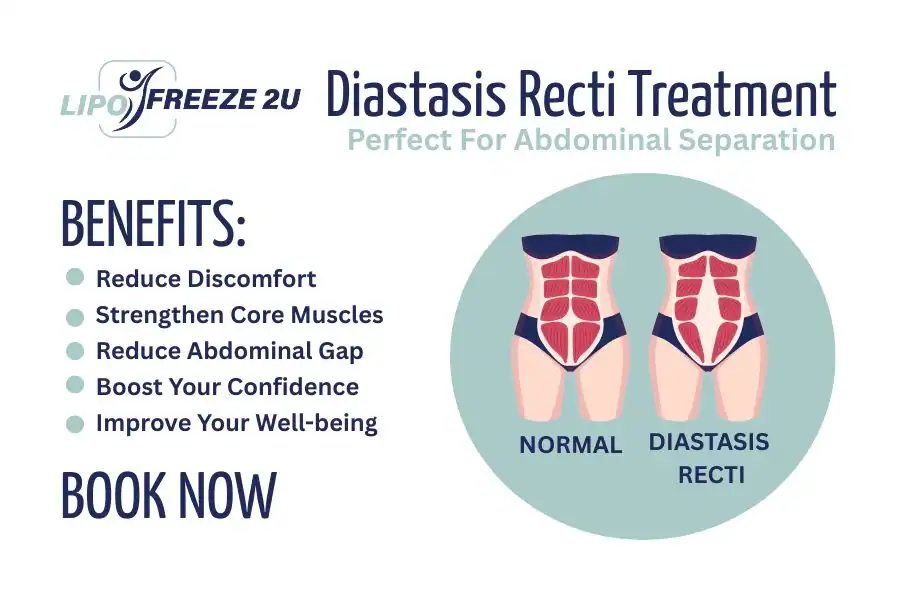 How Long Will It Take to See Improvements in Diastasis Recti Stoke-on-Trent