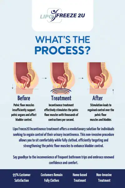 Diagram of how incontinence treatment Stoke-on-Trent works.
