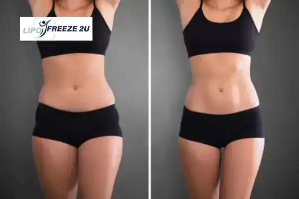 How Can LIPO FREEZE 2U Support Your Post-Pregnancy Body Recovery Stoke-on-Trent?