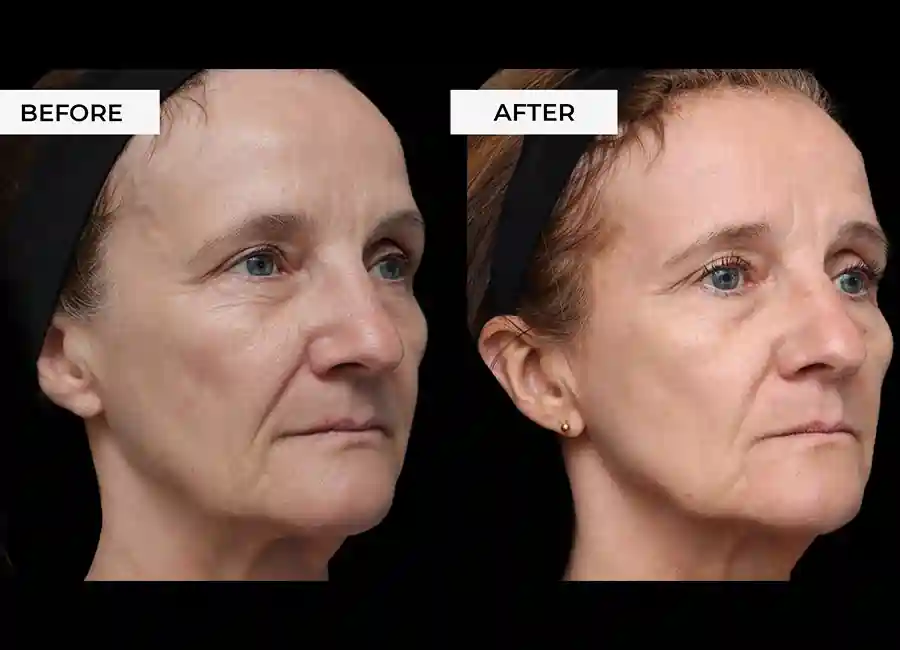 How Many RF Microneedling Sessions Will You Need to See a Difference Stoke-on-Trent?