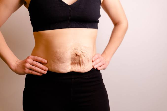 Is Surgery Really the Only Way to Repair Diastasis Recti Stoke-on-Trent?
