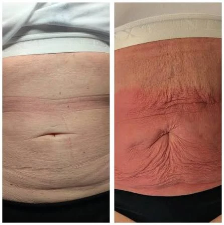 How Does RF Microneedling Improve Crepey, Thin and Uneven Skin Texture Stoke-on-Trent?