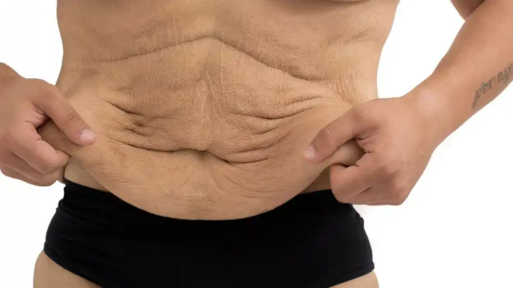 Why Does Weight Loss Medication Leave Some People With Loose or Sagging Skin Stoke-on-Trent?